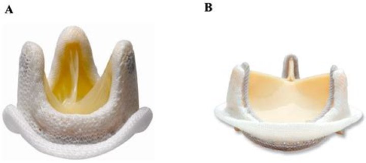 Are prosthesis covered by insurance?
