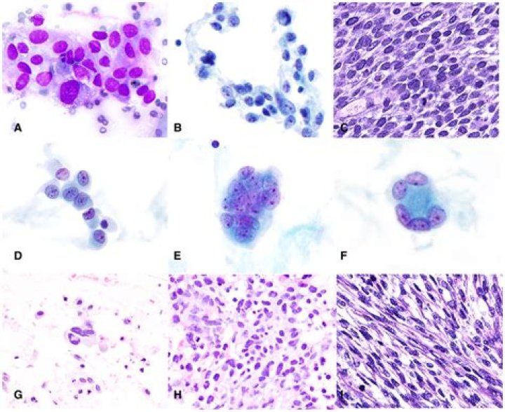 Are Sertoli Leydig tumors benign?