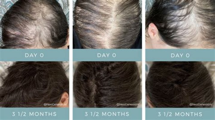 Can cholestyramine cause hair loss