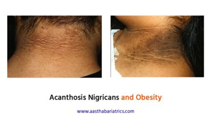 Can losing weight cure acanthosis nigricans?