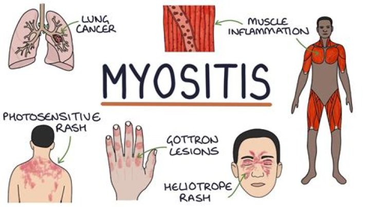 Can myositis cause muscle twitching