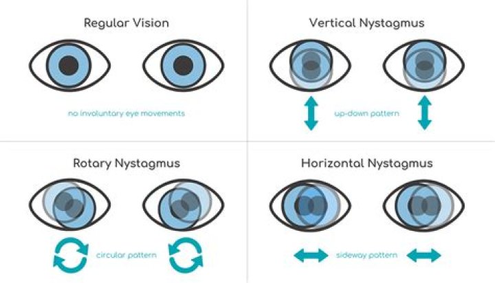 Can nystagmus patients get Lasik?
