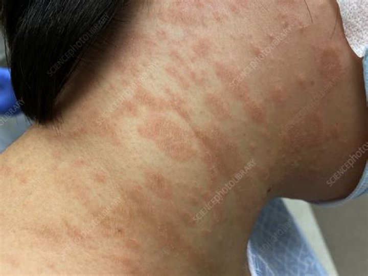 Can pityriasis rosea turn into psoriasis?