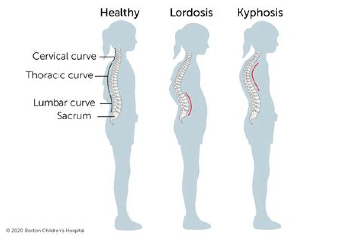 Can slouching cause hunchback
