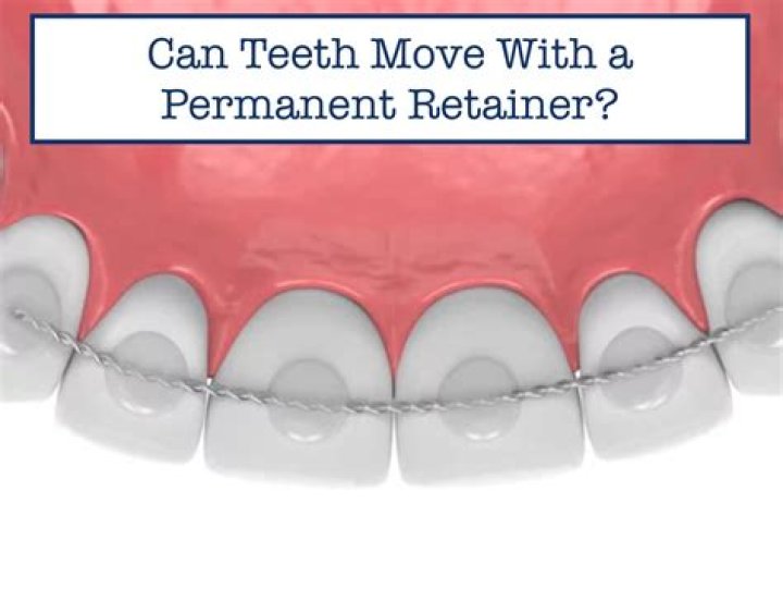 Can teeth move with permanent retainer?