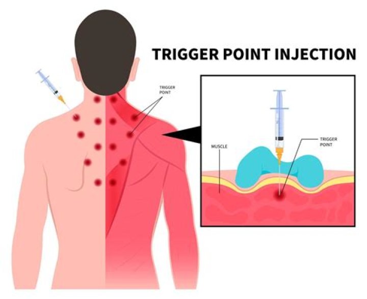 Can trigger point injections help TMJ?