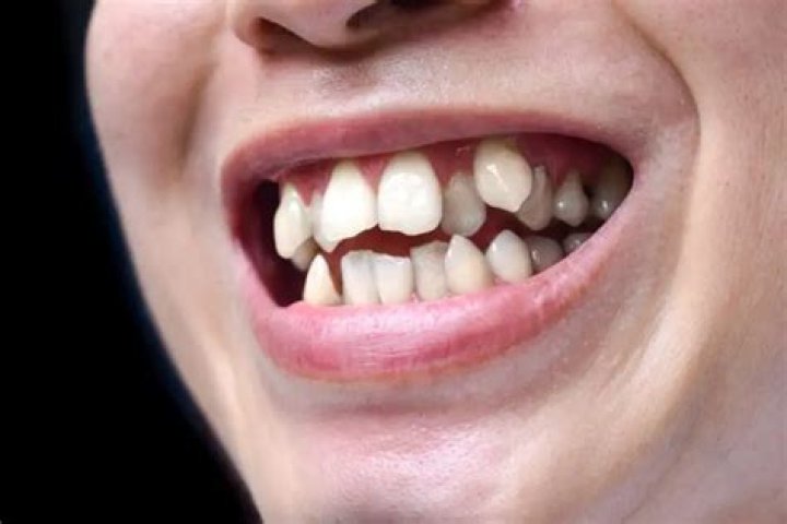Can you file down teeth?
