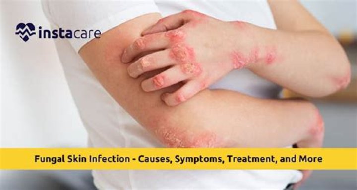 Can you get a fungal infection on your hands