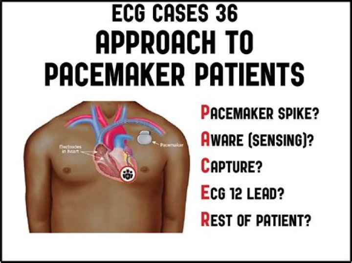 Can you have an EKG with a pacemaker