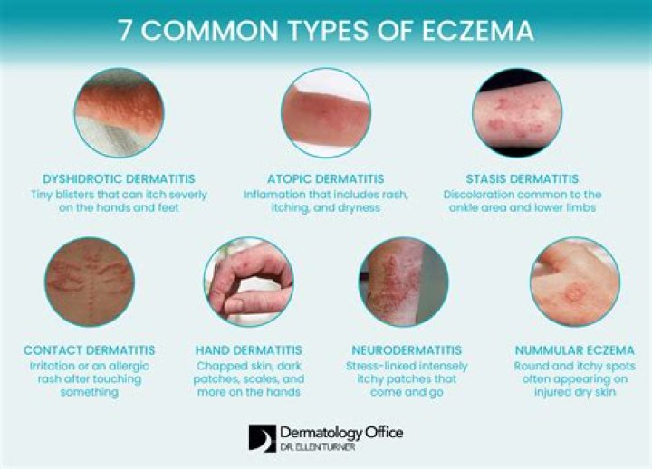 Do saunas help with eczema?