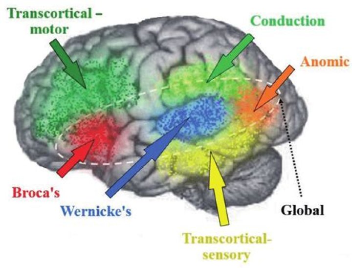 Does anomic aphasia get worse