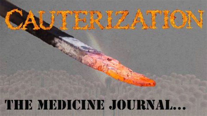 Does cauterizing a wound really work