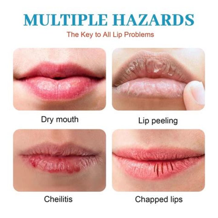 Does Chapstick help chapped nose?