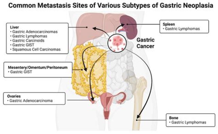 Does gist mean cancer? | ContextResponse.com