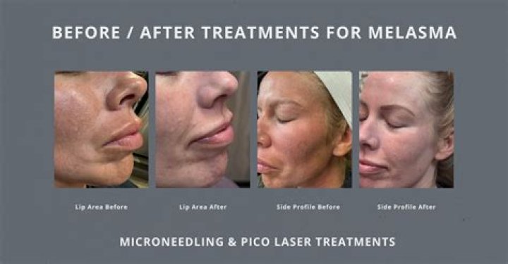 Does laser remove melasma?
