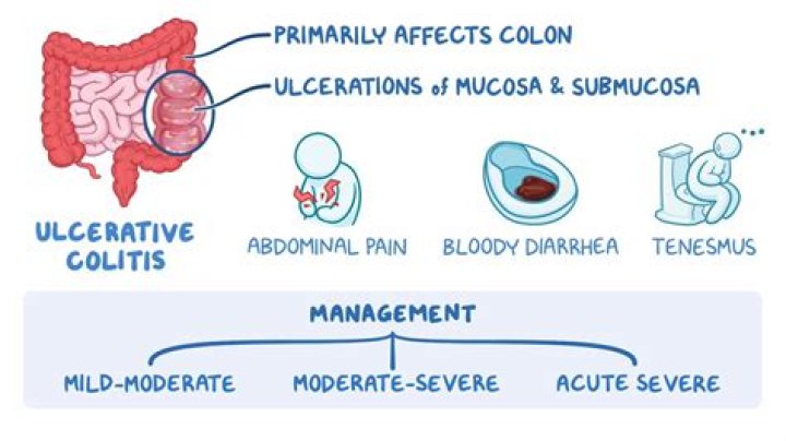 Does ulcerative colitis cause mouth sores?