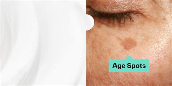 How can I fade age spots naturally?