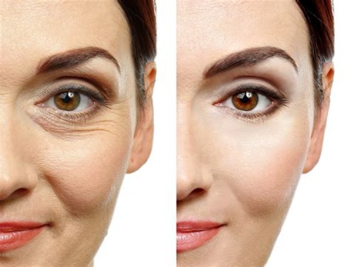 How can I reduce wrinkles under my eyes?