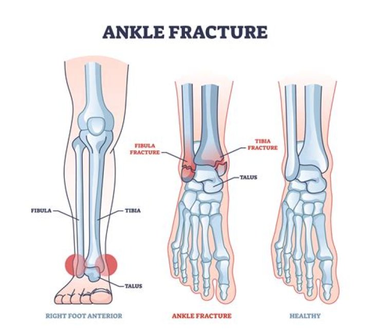 How common are fibula fractures