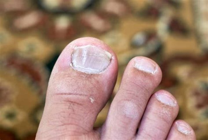 How do I get rid of thick toenails?