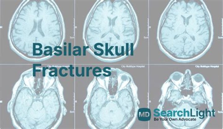 How do you get a basilar skull fracture