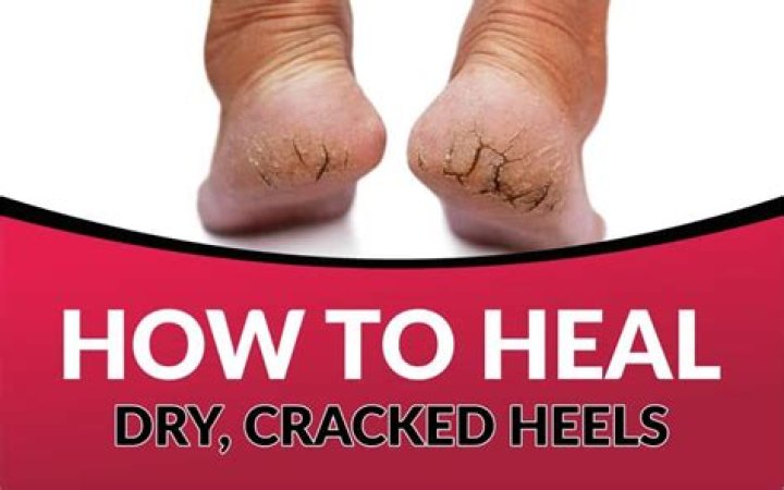 How do you get rid of dry heels?