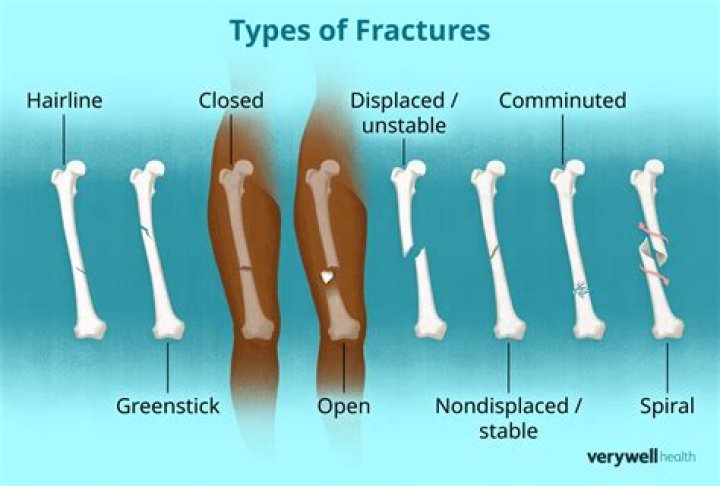 How do you open emergency care for a closed fracture?