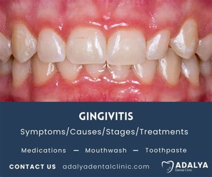 How do you reverse severe gingivitis?