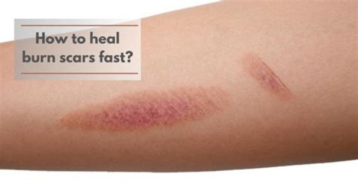 How do you stop a cut from scarring?