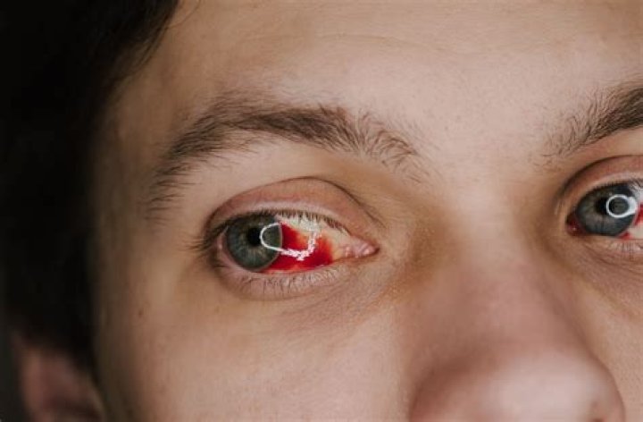 How do you treat a broken blood vessel in your eye?