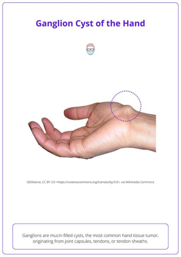 How do you treat a ganglion cyst on hand?