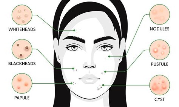 How do you treat chin strap acne?