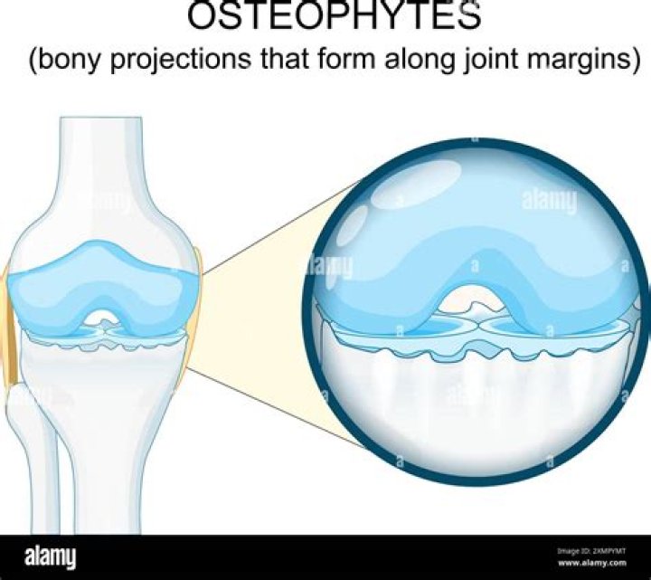 How do you treat osteophytes in the knee?