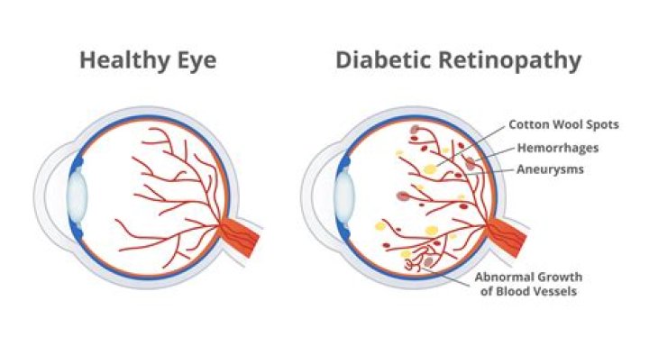 How does diabetic retinopathy affect the retina?