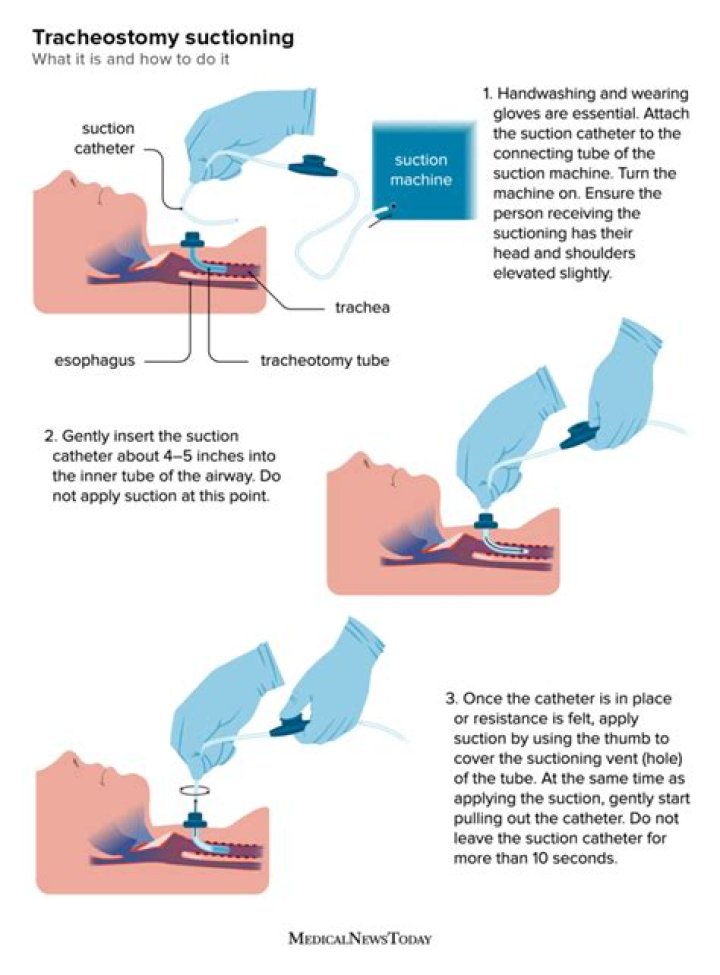 How does tracheostomy prevent aspiration?