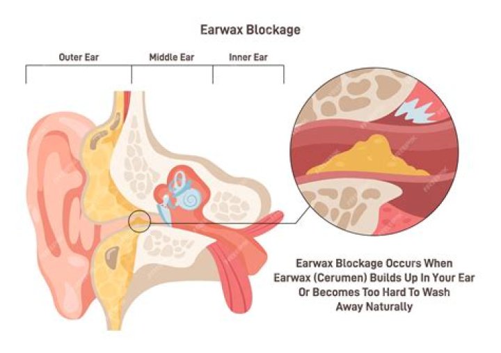 How is cerumen removed? | ContextResponse.com