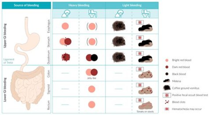 How is GI bleed diagnosed