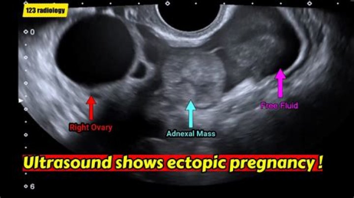 How is TVS ultrasound done?