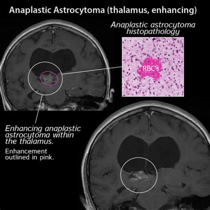 How long can you live with anaplastic astrocytoma?