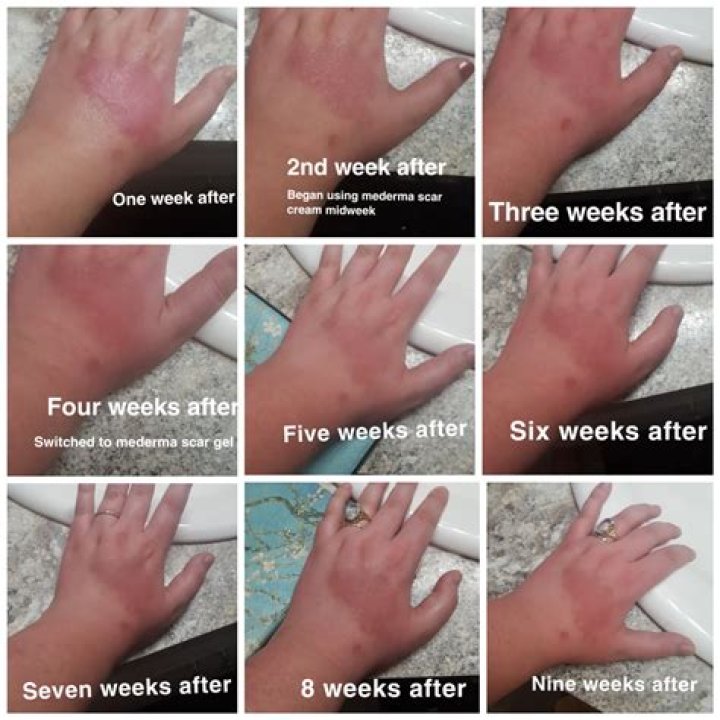 How long does a friction burn take to heal?