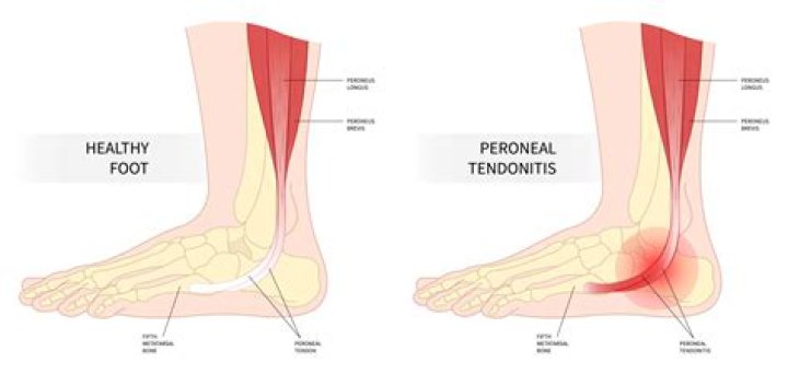 How long does a Tendinopathy take to heal?