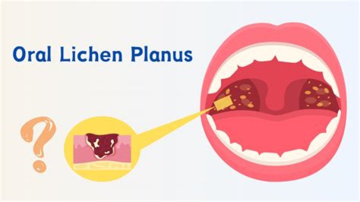 How long does it take for Oral Lichen Planus to go away?