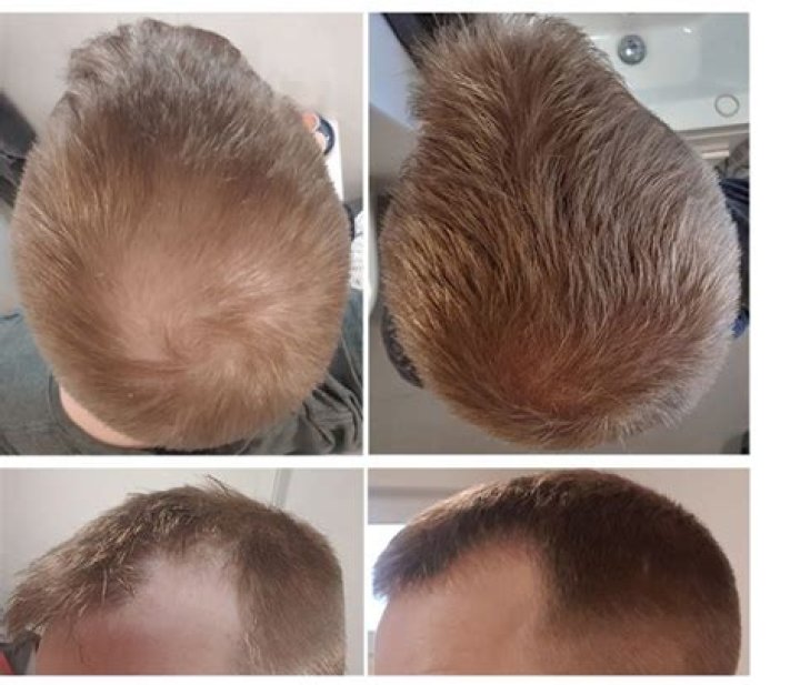 How many mg of finasteride should I take for hair loss?