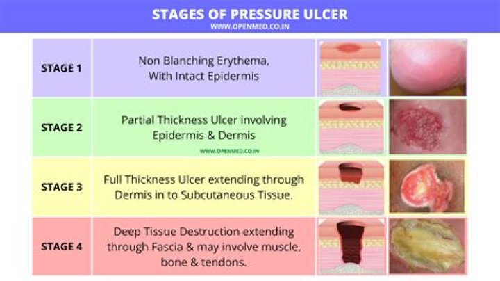 How many stages of pressure ulcers are there