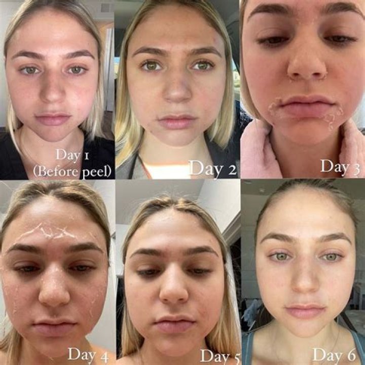 How often can you do glycolic acid peel?