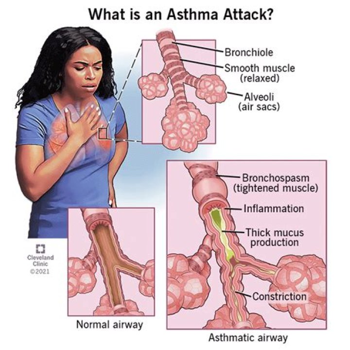 Is asthma and bronchitis the same thing