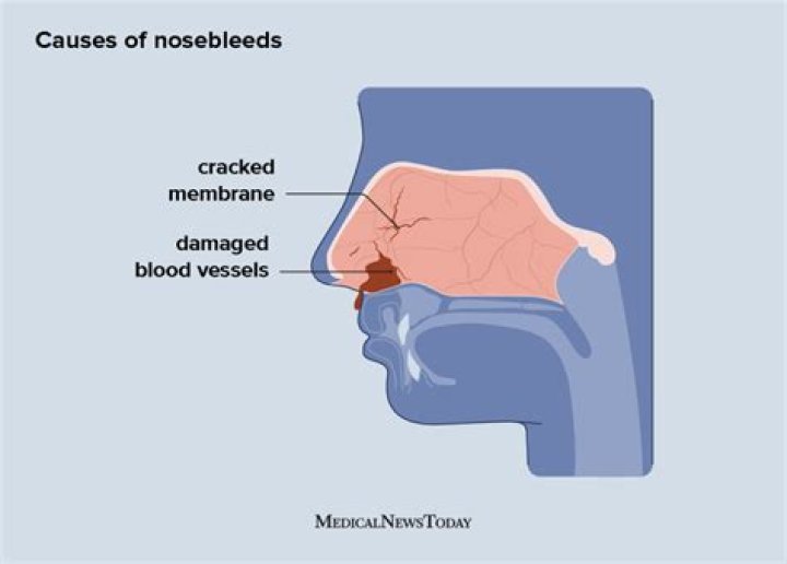 Is blood in nose mucus bad?