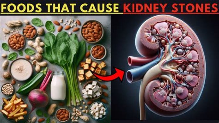 Is Coke good for kidney stones