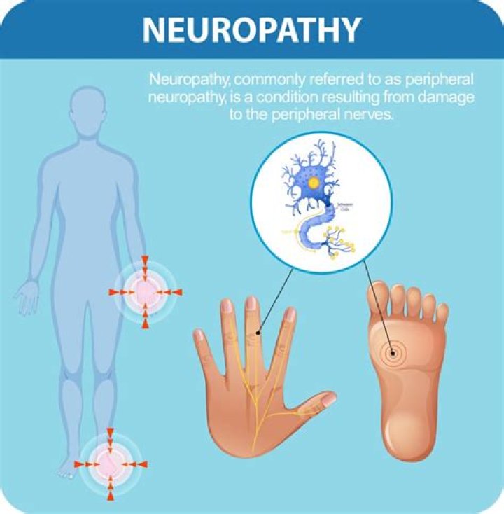 Is neuropathy considered a critical illness?