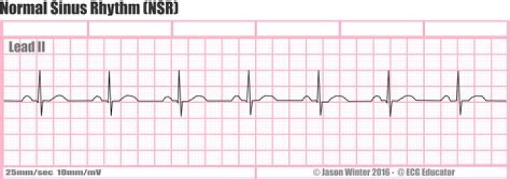 Is normal sinus rhythm good